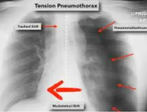 Tension pneumothorax to cut or to poke?