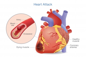 chronic heart failure