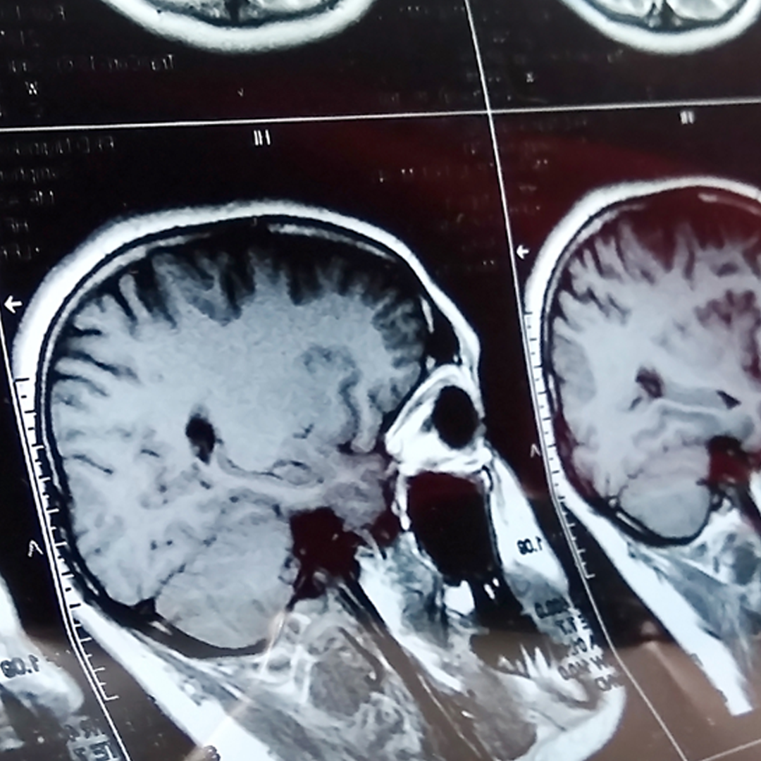 Traumatic brain injury