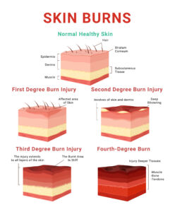 infogrphic describing layers of skin and burn depths