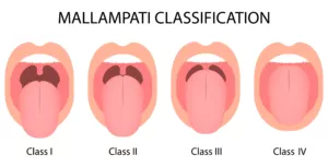 Mallampati scale 